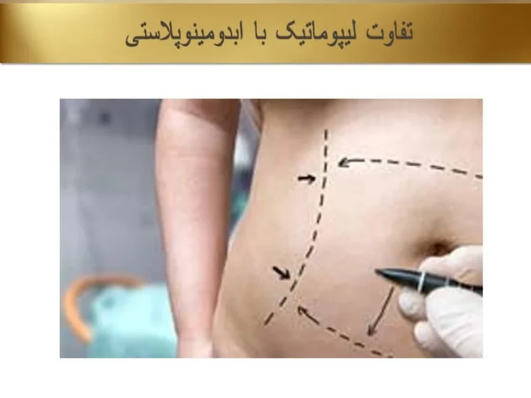 فرق ابدومینوپلاستی با لیپوماتیک چیست؟
