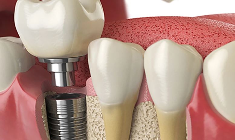 آیا ایمپلنت دندان خطرناک است؟
