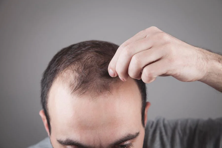 The best hair loss treatment