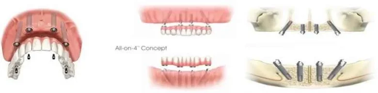 What is the best dental implant