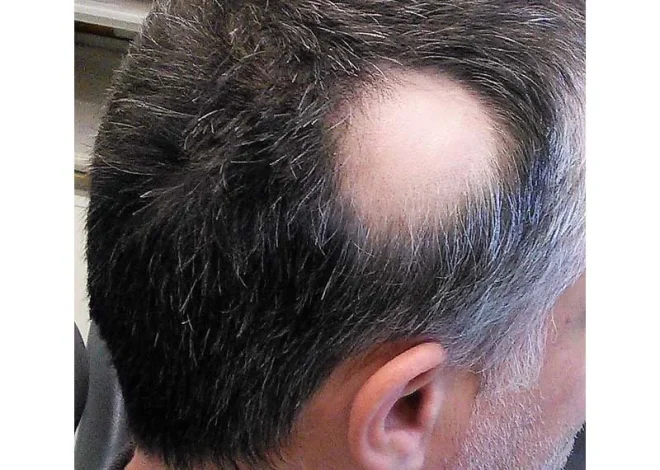 Is hair loss dangerous?