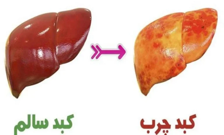 علائم کبد چرب در زنان چیست