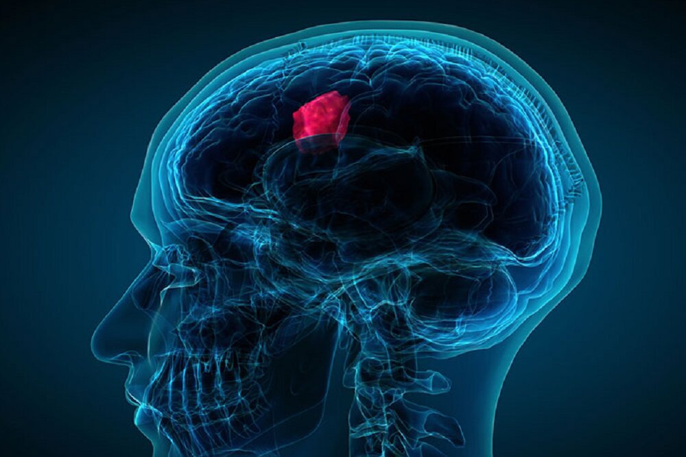 انواع تومورهای مغزی و درمان آنها