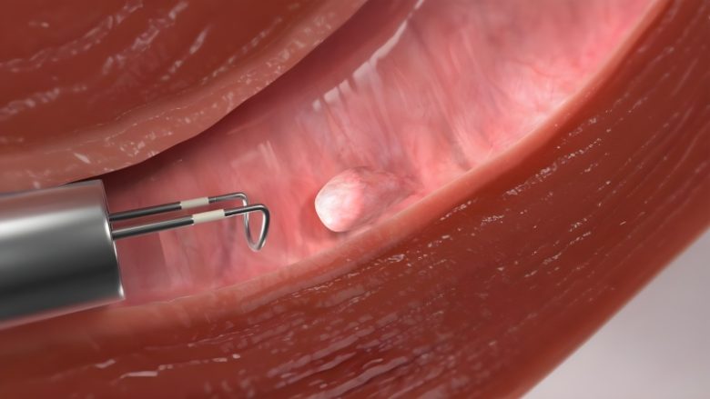 پولیپ رحم چیست؟ علل، علائم و تأثیر آن بر باروری و بارداری