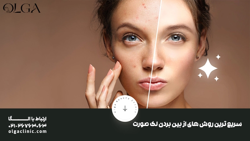 معرفی سریع ترین روش های از بین بردن لک صورت