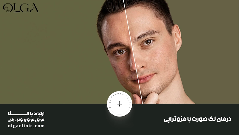 درمان لک صورت با مزوتراپی